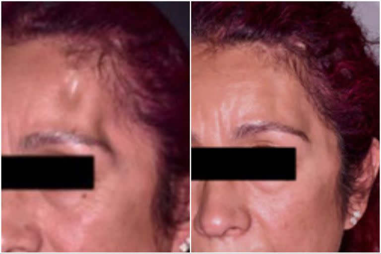 El rostro de una paciente, antes y después de la lipotransferencia