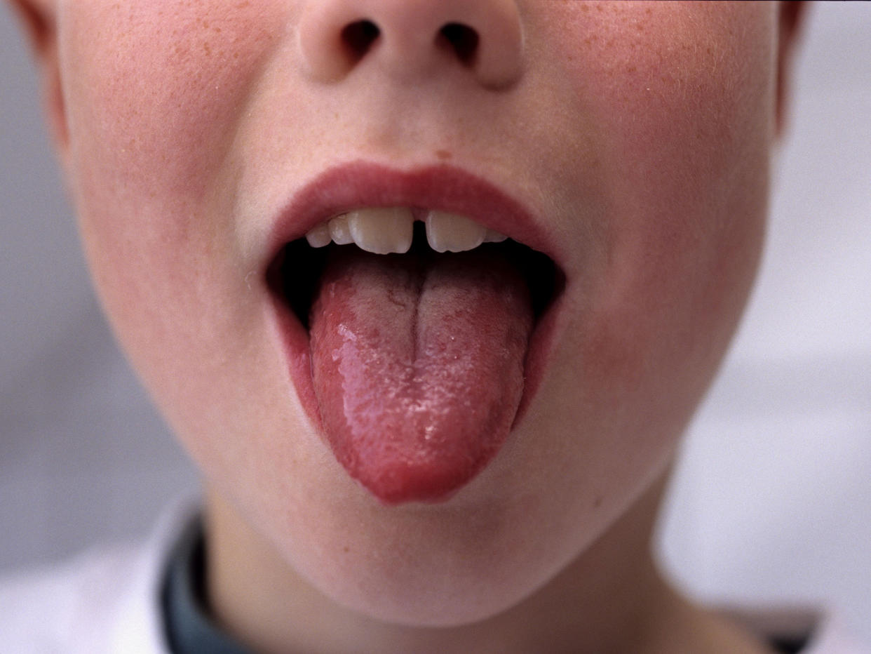 Scarlet fever can cause a swollen tongue: Rex Features