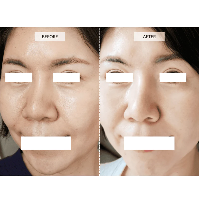 Before and after images of a customer who used the Currentbody LED mask. PHOTO: Currentbody