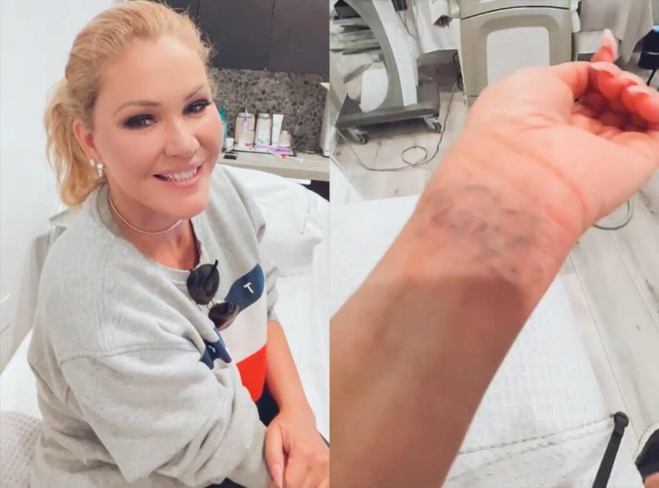 Shanna Moakler, Travis Tattoo Removal