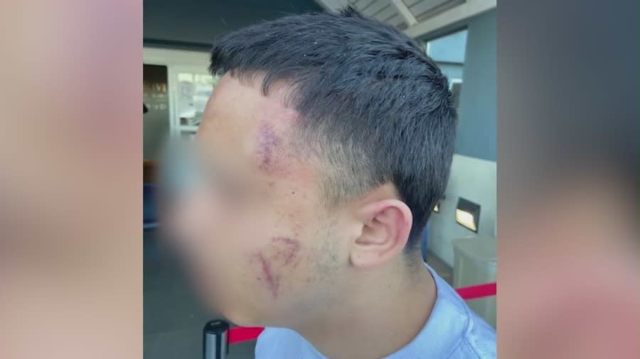 Bruises and scrapes, in addition to a concussion, the 14-year-old suffered as result of the attack (KTLA)