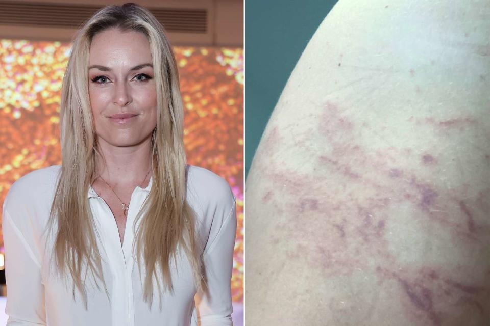 <p>John Lamparski/Getty Images; Lindsey Vonn Instagram</p> Lindsey Vonn (L) and her jellyfish sting