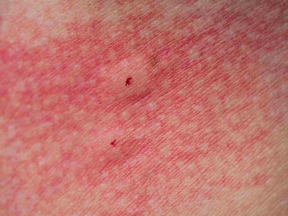 close-up shot of red, inflamed bug bite