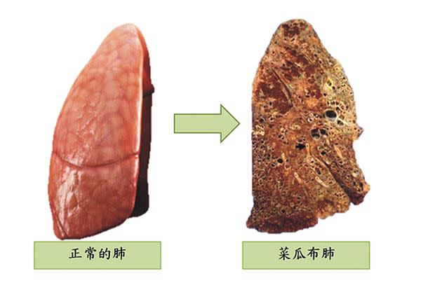 圖1、正常的肺（左）及菜瓜布肺（右）。（圖片／李吉泰醫師提供）