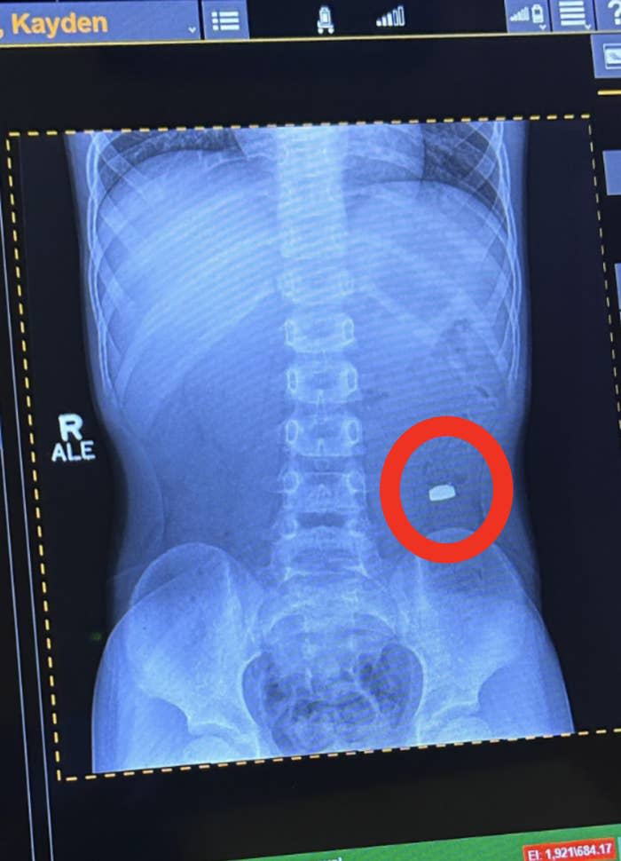 X-ray image of a person's abdomen and spine. The name "Kayden" is visible at the top but not relevant to the content of the image