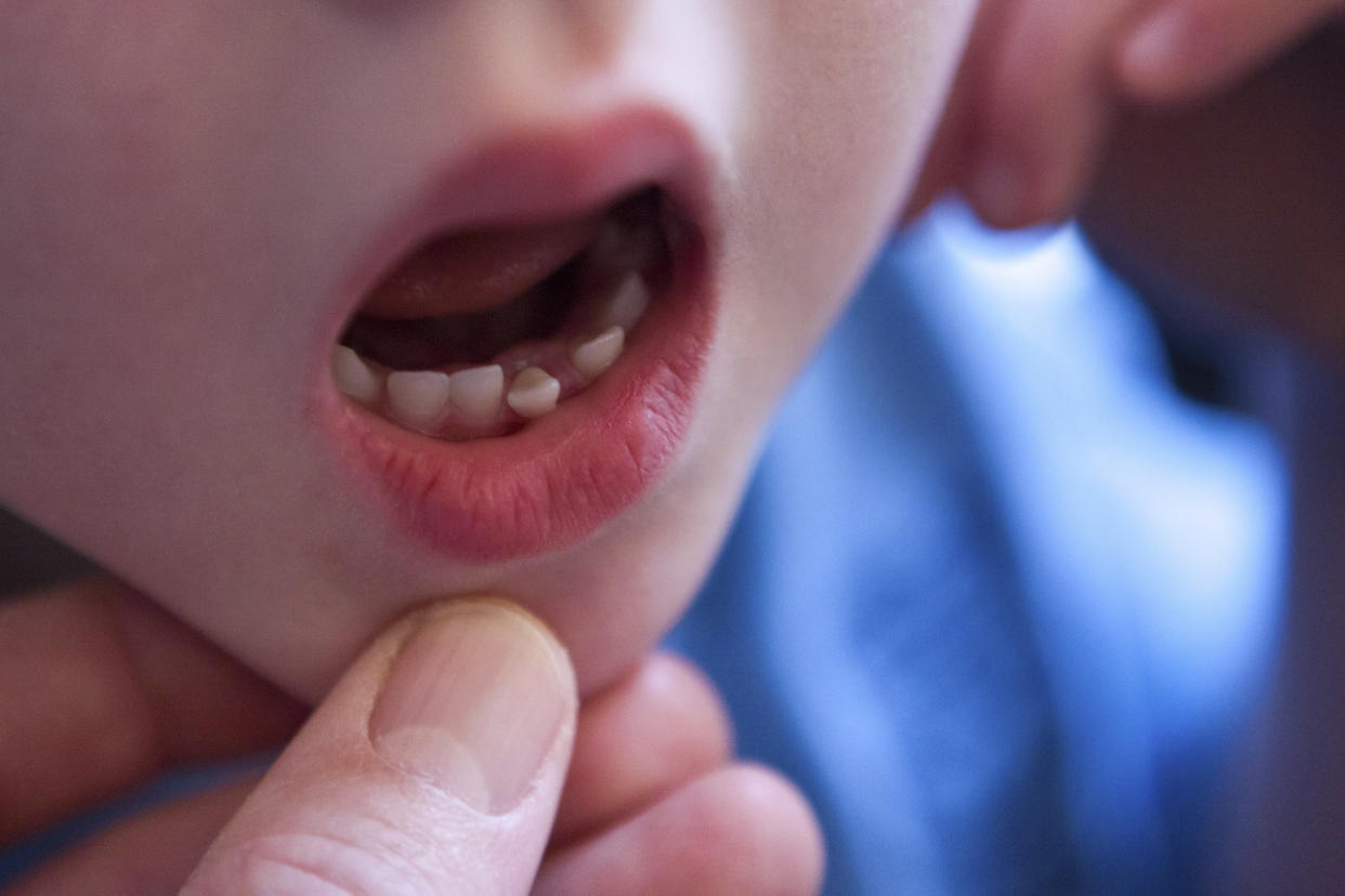A first-grader in Wisconsin misplaced his lost tooth but his principal made sure the Tooth Fairy came anyway. (Photo: Getty Images)