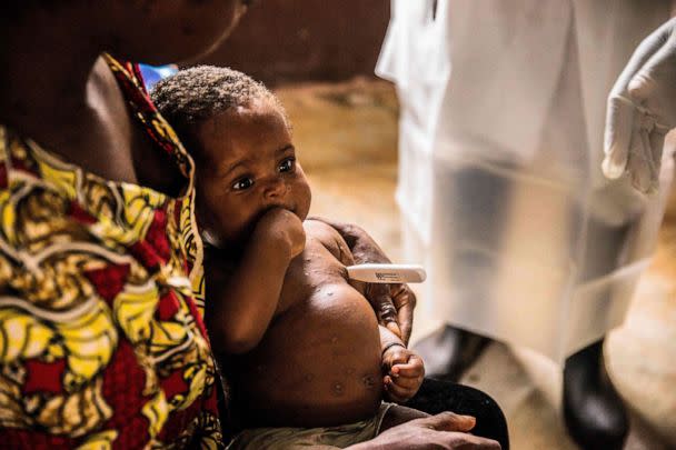 PHOTO: A woman and her child, both infected with monkeypox await treatment at the quarantine of the centre of the International medical NGO Doctors Without BorderS, in Zomea Kaka, in the Central African Republic, on Oct. 18, 2018.   (Charles Bouessel/AFP via Getty Images, FILE)