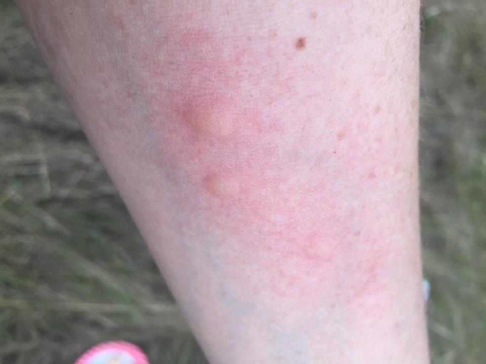 West Nile virus is spread by an infected mosquito delivering it to a human through a bite.