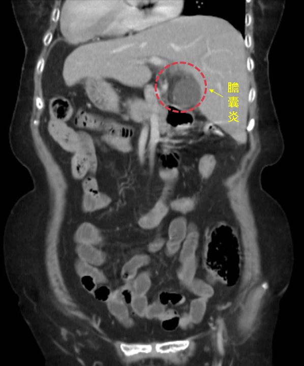 阿嬤被診斷為膽囊發炎。（圖／中醫大新竹附醫提供）
