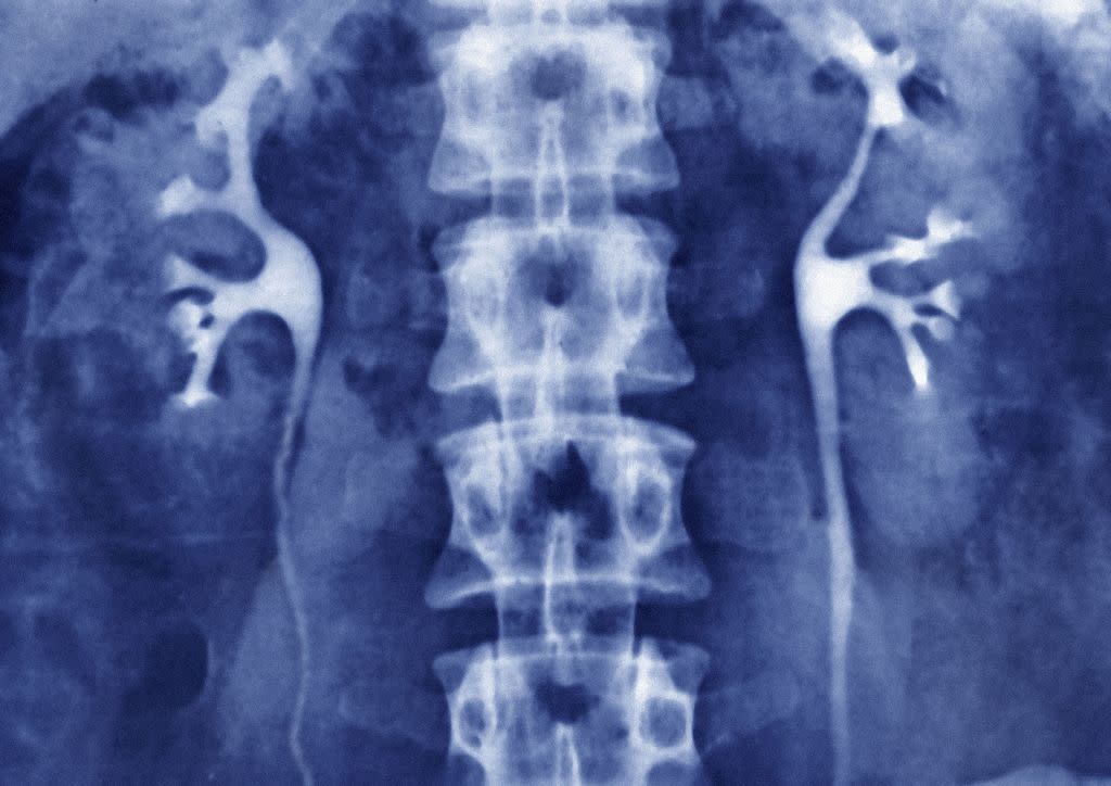 https://www.gettyimages.co.uk/detail/news-photo/kidney-x-ray-urography-in-front-view-normal-kidneys-and-news-photo/179797459?adppopup=true