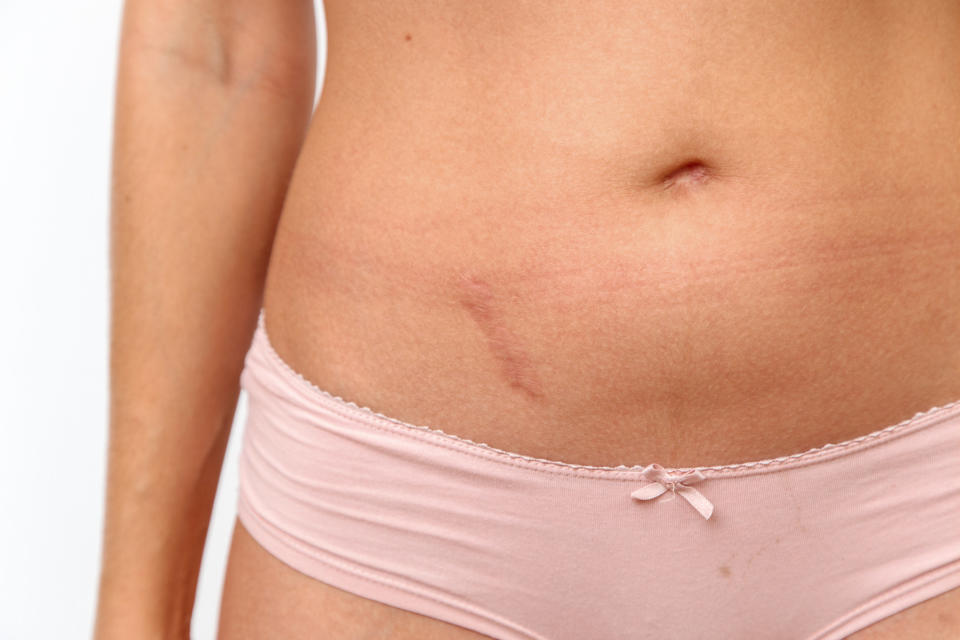 Woman with an appendix scar