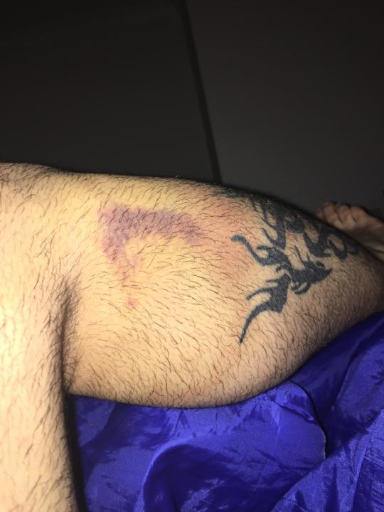Pictured is a bruise above a tattoo on Mark Demosani's leg after the motorcycle crash. 