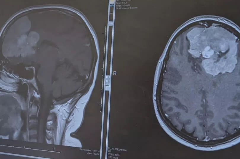 Caroline's scan showing her brain tumour