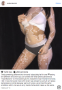 Twenty-one-year-old Ashley Soto uses her skin as a canvas to recreate famous art works, to show off her vitiligo and teach others about the skin condition.