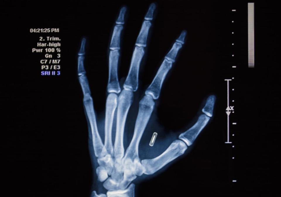 Microchip Hand Implant