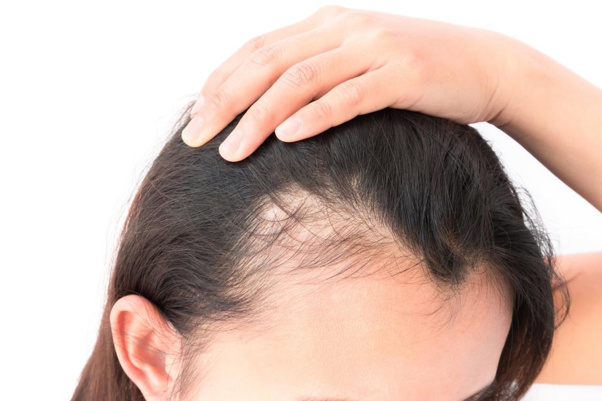 woman serious hair loss problem