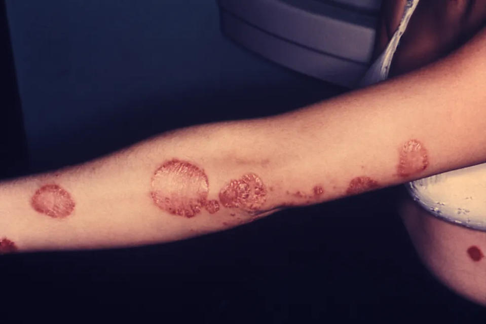 Psoríase não deve ser encarada apenas como um problema de pele, já que a doença é sistêmica (Imagem: Dr. N.J. Fiumara/CDC)