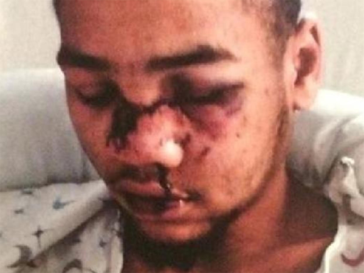 Tyran Dobbs suffered broken facial bones, a fractured rib and bruised lungs after being shot with rubber bullets by police: Screengrab