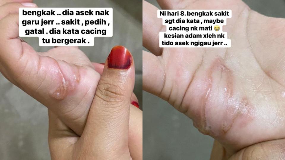 馬來西亞1名3歲男童在沙堆玩耍後全身發癢，經檢查確認是有寄生蟲鑽進體內。（圖／翻攝自臉書）