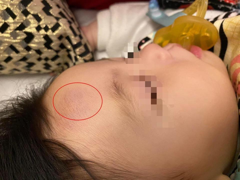 女兒因從嬰兒床摔落到地板，額頭腫了一塊瘀青。（翻攝自爆料公社公開版）