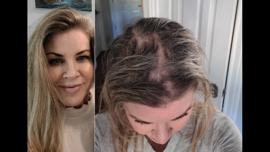 This photo is one example of hair loss and scalp injuries allegedly caused by Olaplex products.