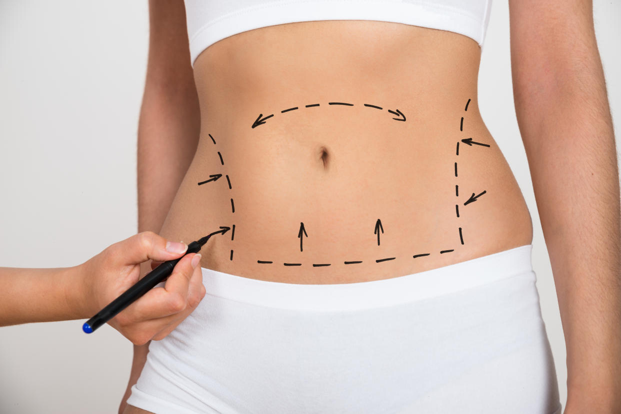 Women are getting surgery to change the shape and size of their belly buttons [Photo: Getty]