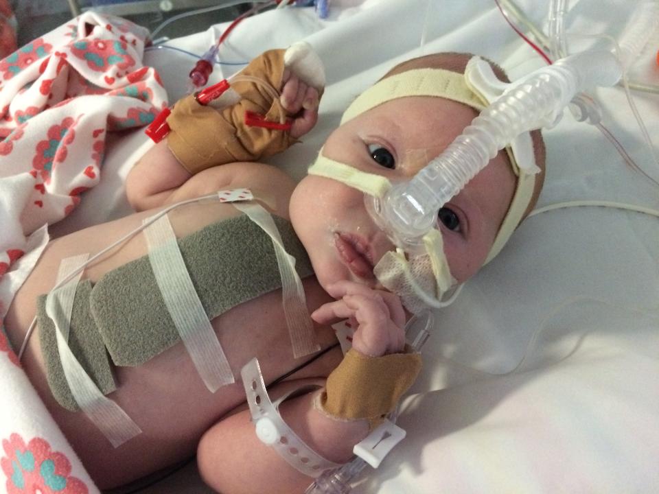 Eva was diagnosed with a congenital heart defect before birth. Photo: Supplied/Aimee Baglin