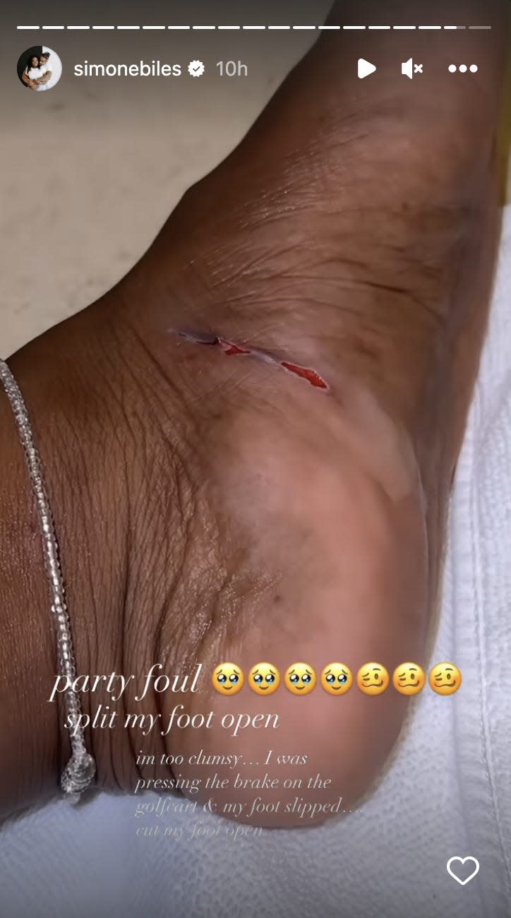 Biles shared a close-up shot of the cut on her Instagram story.