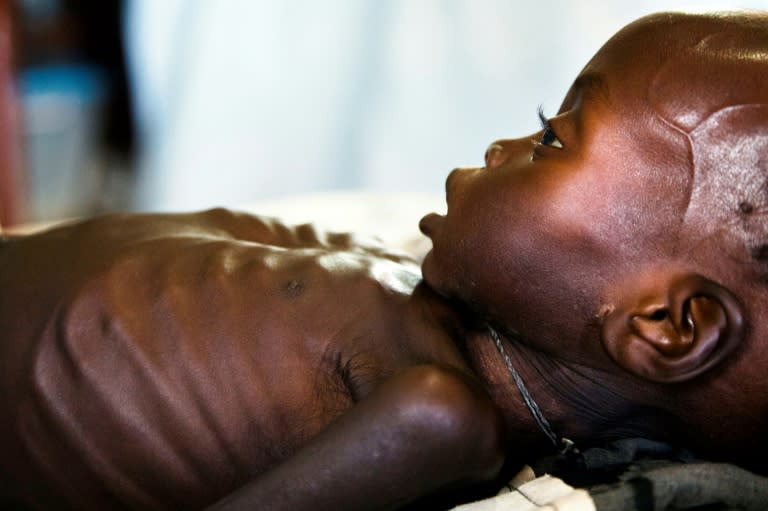 Agop Manut (11 months), at the clinic run by Doctors without Borders (MSF) in Aweil, Northern Bahr al Ghazal, South Sudan, last October