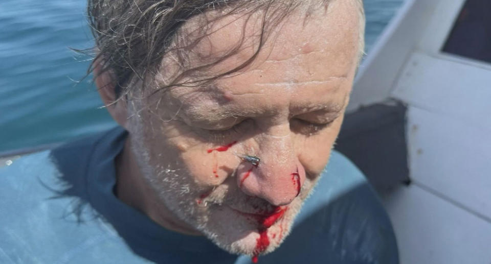 A photo of a Perth carpenter with blood on his face from and a garfish beak stuck in his nose.