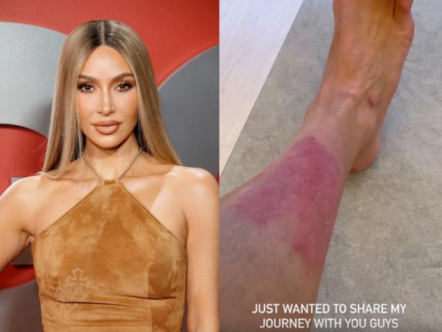 Kim Kardashian shares close-up look at 'painful' psoriasis flareup