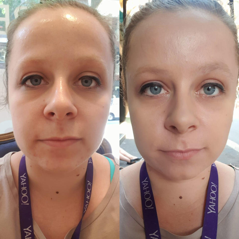 clear skinscare skin peel results