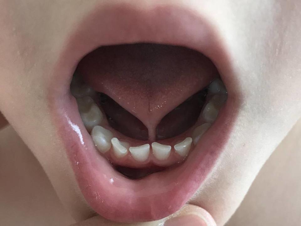 Tongue-tie, or ankyloglossia, in a child. A procedure performed by some dentists uses a laser to cut into the front portion of the tissue under the tongue, freeing it.