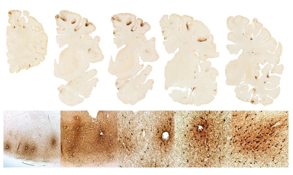 The top row shows severe deposition of tau protein in the frontal lobes of Hernandezs brain The bottom shows microscopic deposition of tau protein in nerve cells a unique feature of CTE (Photo: Boston University)