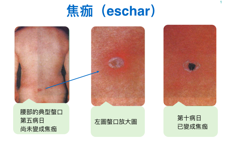 被恙蟎叮咬的地方會出現焦痂。   圖：衛福部疾病管制署/提供