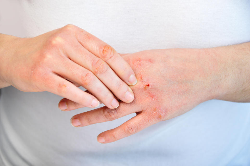 Woman checking the hand with very dry skin and deep cracks