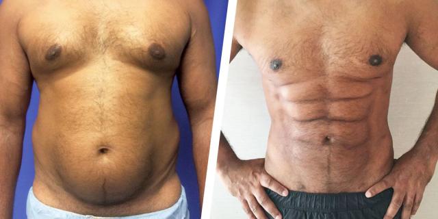 This Plastic Surgery Procedure Gives You Six-Pack Abs