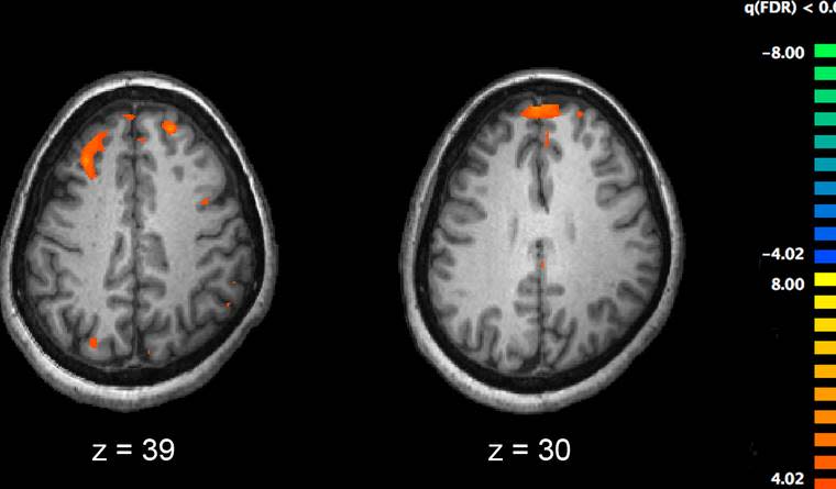 Science May Have Moved Much Closer to Curing Schizophrenia