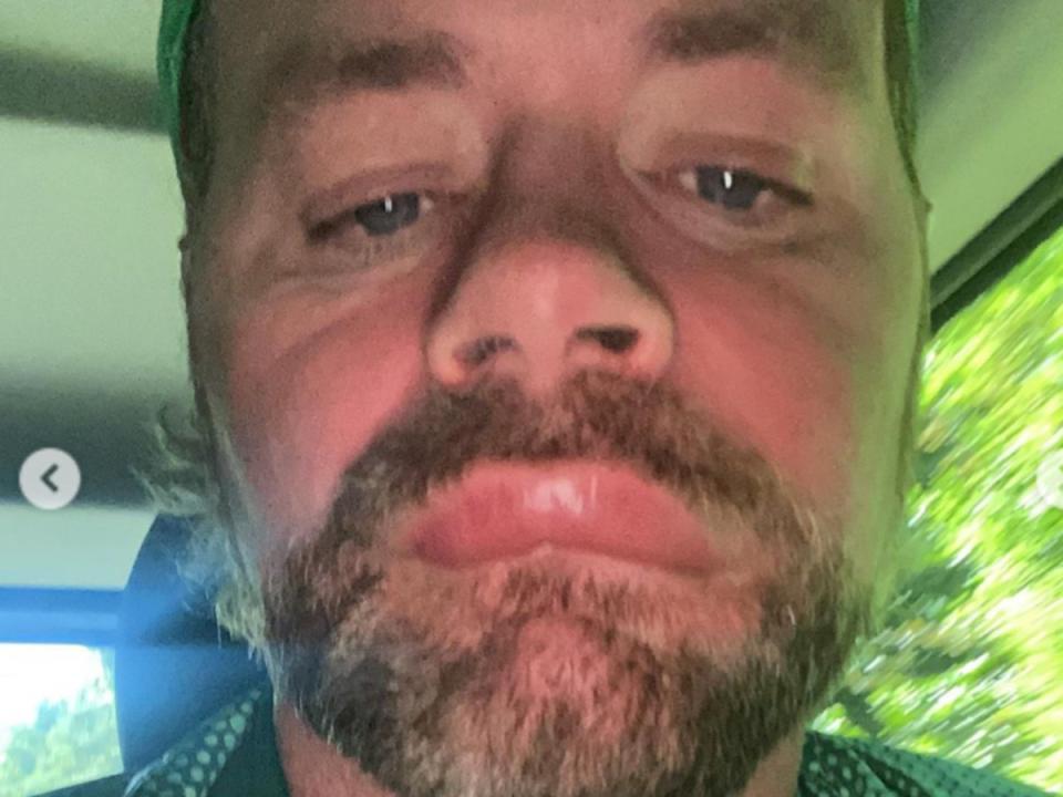 Brian McFadden shared the allergic reaction he suffered after a bee stung his face (Instagram)