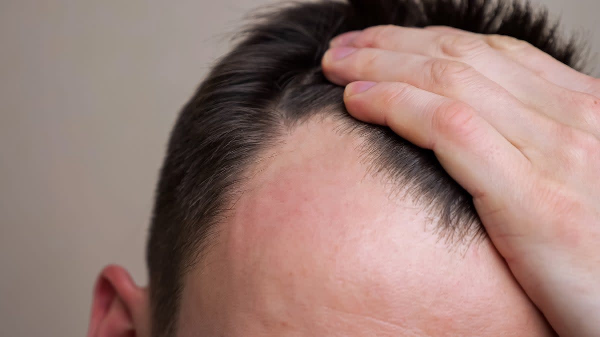 Baldness can affect both men and women  (Getty Images/iStockphoto)