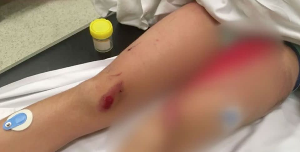 Michelle Nash's daughter Taylor suffered deep grazing on her legs. Source: 7 News