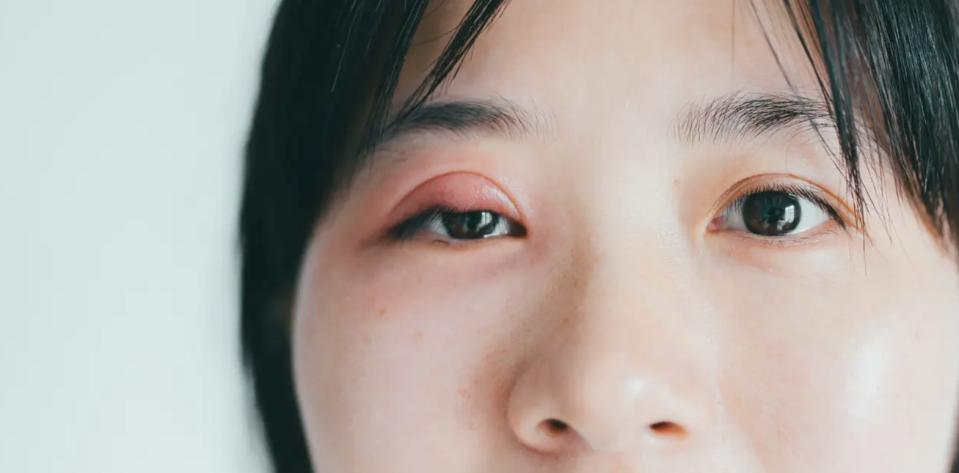 Geschwollene Augen können viele Ursachen haben. - Copyright: PansLaos/Getty Images