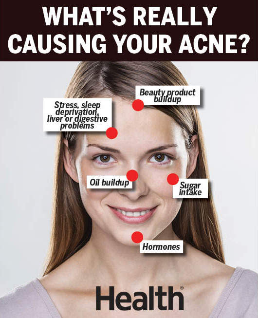 Face mapping your acne and what it means on your face revealed