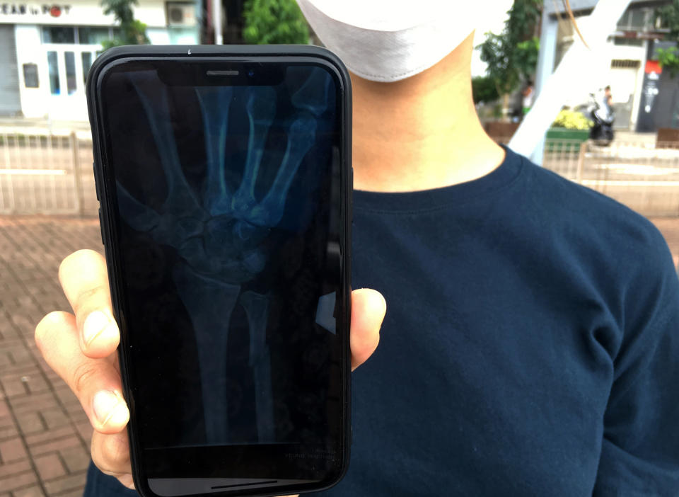 In this Oct. 7, 2019, photo, an organizer of an underground network of volunteer Hong Kong medics that are treating injured protesters shows an X-ray image on her mobile phone that revealed a fracture above the left wrist of a protester in Hong Kong. The 22-year-old protester, too scared to seek treatment in government hospitals, reached out to the network using an encrypted messaging app and said he’d been struck by a baton on his arm. (AP Photo/John Leicester)