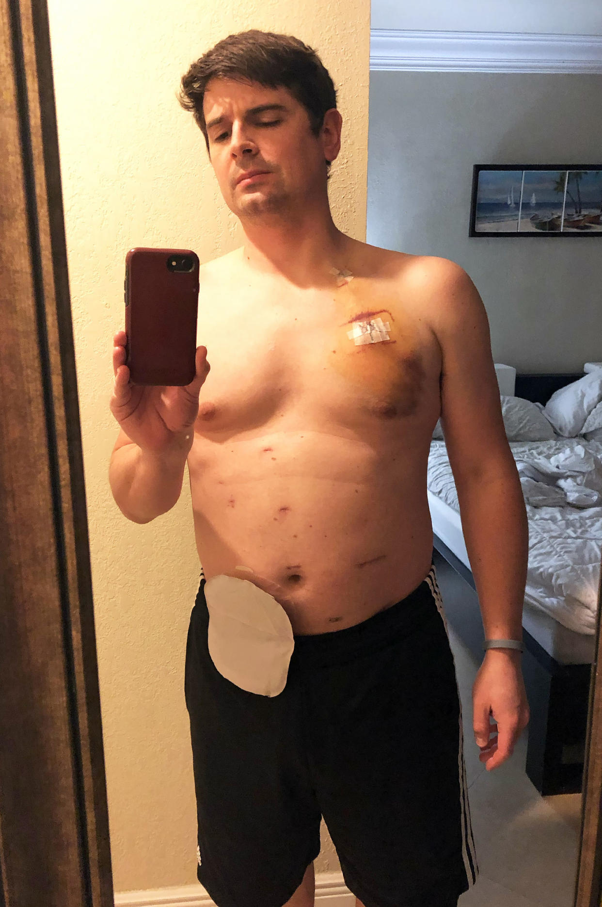 To help with his recovery, doctors gave Michael Sheridan a colostomy bag. After treatment ended it was reversed.  (Courtesy Michael Sheridan)
