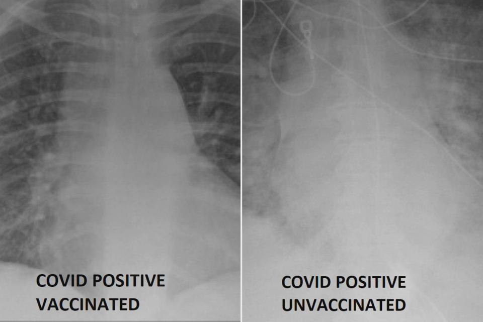 COVID-19 lung x-rays show difference getting the vaccine can make