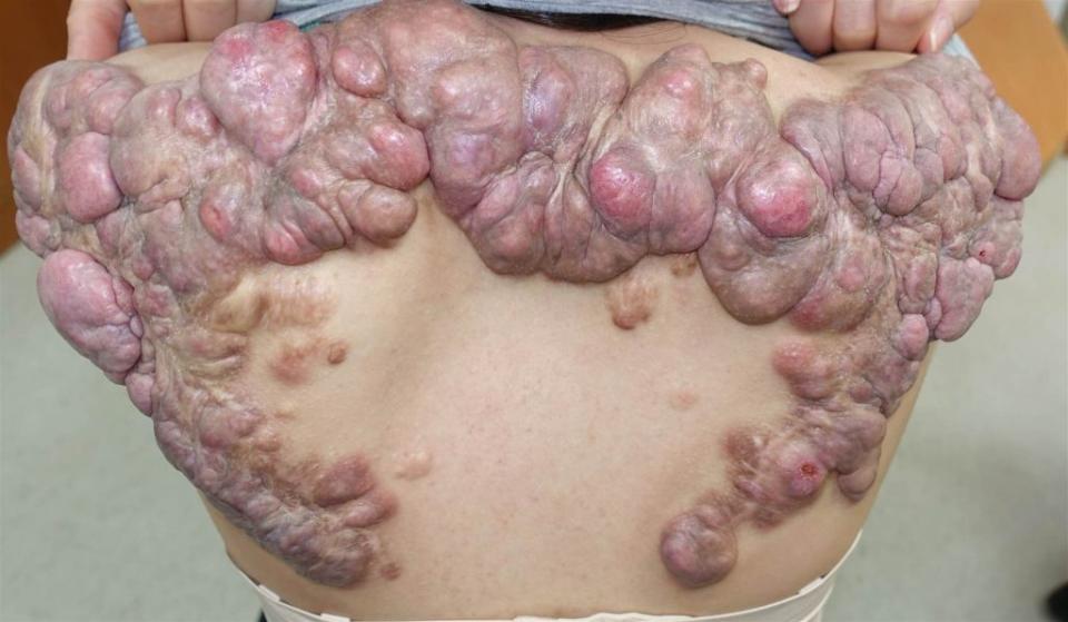 27歲陳小姐因抓破背上痘痘，蟹足腫向傷口以外的正常部位過度增生。（長庚醫院提供／中央社）