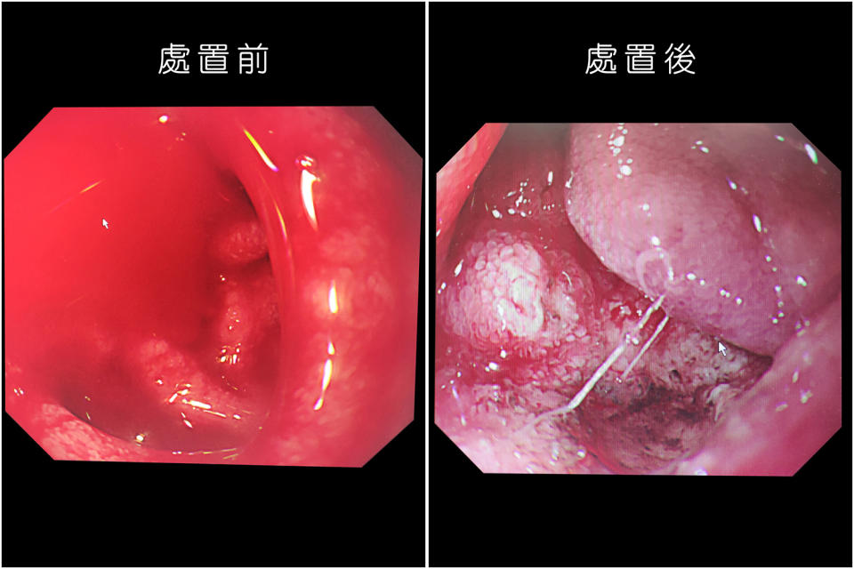 上消化道出血內視鏡治療前後。（賴廷翰攝）