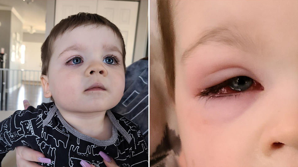 Two-year-old Baylor almost lost his eyesight after playing with a bath toy. Source: Facebook/Eden Strong - No Shame