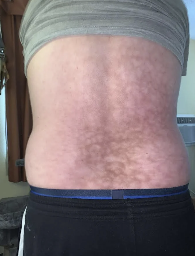 Skin with a pattern of darker patches, possibly a skin condition or birthmark, on a person's back